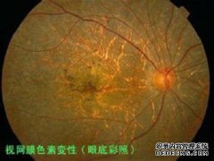 视网膜色素变性论坛rp家？