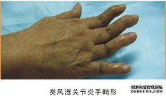 如何确定您是否患有风湿病