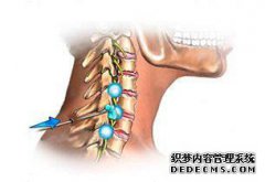 您知道强直性颈椎病最有效的预防措施吗？强大