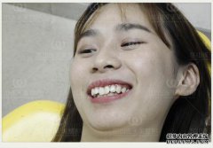 如果在正畸治疗之前拔掉4颗牙齿，会不会有后遗
